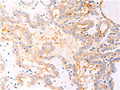 The image on the left is immunohistochemistry of paraffin-embedded Human thyroid cancer tissue using CSB-PA617153(RELA Antibody) at dilution 1/25, on the right is treated with fusion protein. (Original magnification: ×200)