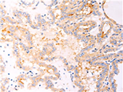 The image on the left is immunohistochemistry of paraffin-embedded Human thyroid cancer tissue using CSB-PA617153(RELA Antibody) at dilution 1/25, on the right is treated with fusion protein. (Original magnification: ×200)
