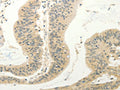 The image on the left is immunohistochemistry of paraffin-embedded Human colon cancer tissue using CSB-PA617545(FZD8 Antibody) at dilution 1/30, on the right is treated with synthetic peptide. (Original magnification: ×200)