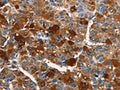 The image on the left is immunohistochemistry of paraffin-embedded Human liver cancer tissue using CSB-PA617569(ARMCX2 Antibody) at dilution 1/40, on the right is treated with fusion protein. (Original magnification: ×200)