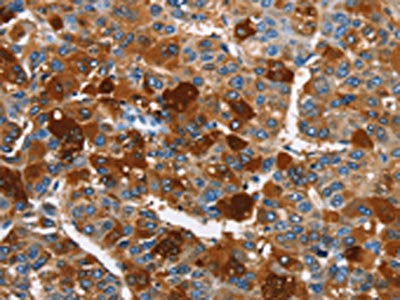 The image on the left is immunohistochemistry of paraffin-embedded Human liver cancer tissue using CSB-PA617569(ARMCX2 Antibody) at dilution 1/40, on the right is treated with fusion protein. (Original magnification: ×200)