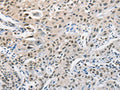The image on the left is immunohistochemistry of paraffin-embedded Human lung cancer tissue using CSB-PA617763(CDC27 Antibody) at dilution 1/50, on the right is treated with fusion protein. (Original magnification: ×200)