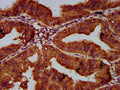 IHC image of CSB-PA617942LA01HU diluted at 1:600 and staining in paraffin-embedded human endometrial cancer performed on a Leica BondTM system. After dewaxing and hydration, antigen retrieval was mediated by high pressure in a citrate buffer (pH 6.0). Section was blocked with 10% normal goat serum 30min at RT. Then primary antibody (1% BSA) was incubated at 4&deg;C overnight. The primary is detected by a biotinylated secondary antibody and visualized using an HRP conjugated SP system.