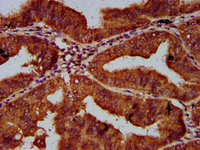 IHC image of CSB-PA617942LA01HU diluted at 1:600 and staining in paraffin-embedded human endometrial cancer performed on a Leica BondTM system. After dewaxing and hydration, antigen retrieval was mediated by high pressure in a citrate buffer (pH 6.0). Section was blocked with 10% normal goat serum 30min at RT. Then primary antibody (1% BSA) was incubated at 4&deg;C overnight. The primary is detected by a biotinylated secondary antibody and visualized using an HRP conjugated SP system.