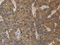 The image on the left is immunohistochemistry of paraffin-embedded Human liver cancer tissue using CSB-PA617990(DEGS1 Antibody) at dilution 1/40, on the right is treated with fusion protein. (Original magnification: ×200)