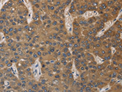 The image on the left is immunohistochemistry of paraffin-embedded Human liver cancer tissue using CSB-PA617990(DEGS1 Antibody) at dilution 1/40, on the right is treated with fusion protein. (Original magnification: ×200)