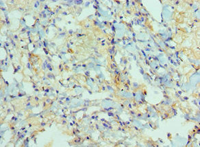 Immunohistochemistry of paraffin-embedded human lung cancer using CSB-PA618774ESR2HU at dilution of 1:100