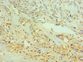 Immunohistochemistry of paraffin-embedded human breast cancer using CSB-PA619082ESR1HU at dilution of 1:100