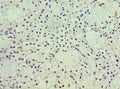 Immunohistochemistry of paraffin-embedded human breast cancer using CSB-PA619962ESR2HU at dilution of 1:100