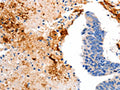 The image on the left is immunohistochemistry of paraffin-embedded Human colon cancer tissue using CSB-PA619982(CCNC Antibody) at dilution 1/15, on the right is treated with fusion protein. (Original magnification: ×200)