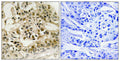 Immunohistochemistry analysis of paraffin-embedded human breast carcinoma tissue using Myb (Phospho-Ser532) antibody. The picture on the right is treated with the synthesized peptide.