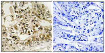 Immunohistochemistry analysis of paraffin-embedded human breast carcinoma tissue using Myb (Phospho-Ser532) antibody. The picture on the right is treated with the synthesized peptide.