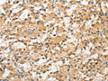 The image on the left is immunohistochemistry of paraffin-embedded Human thyroid cancer tissue using CSB-PA620044(STAM Antibody) at dilution 1/40, on the right is treated with fusion protein. (Original magnification: ×200)