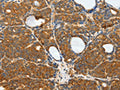 The image on the left is immunohistochemistry of paraffin-embedded Human thyroid cancer tissue using CSB-PA620256(RPS6KB1 Antibody) at dilution 1/25, on the right is treated with fusion protein. (Original magnification: ×200)