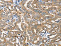 The image on the left is immunohistochemistry of paraffin-embedded Human thyroid cancer tissue using CSB-PA620280(TNFRSF21 Antibody) at dilution 1/20, on the right is treated with fusion protein. (Original magnification: ×200)