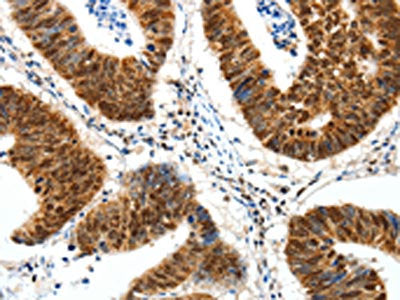 The image on the left is immunohistochemistry of paraffin-embedded Human colon cancer tissue using CSB-PA620368(SP1 Antibody) at dilution 1/30, on the right is treated with synthetic peptide. (Original magnification: ×200)