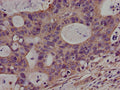 Immunohistochemistry of paraffin-embedded human colon cancer using CSB-PA620966LA01HU at dilution of 1:100