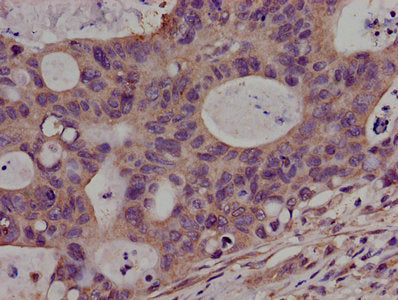 Immunohistochemistry of paraffin-embedded human colon cancer using CSB-PA620966LA01HU at dilution of 1:100