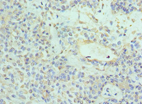 Immunohistochemistry of paraffin-embedded human breast cancer using CSB-PA621947ESR1HU at dilution of 1:100