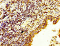 IHC image of CSB-PA621973LA01HU diluted at 1:200 and staining in paraffin-embedded human lung cancer performed on a Leica BondTM system. After dewaxing and hydration, antigen retrieval was mediated by high pressure in a citrate buffer (pH 6.0). Section was blocked with 10% normal goat serum 30min at RT. Then primary antibody (1% BSA) was incubated at 4&deg;C overnight. The primary is detected by a biotinylated secondary antibody and visualized using an HRP conjugated SP system.