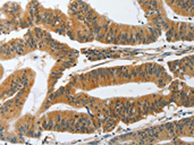 The image on the left is immunohistochemistry of paraffin-embedded Human colon cancer tissue using CSB-PA622420(PIK3R3 Antibody) at dilution 1/45, on the right is treated with synthetic peptide. (Original magnification: ×200)