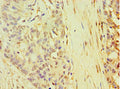 Immunohistochemistry of paraffin-embedded human endometrial cancer using CSB-PA623007ESR1HU at dilution of 1:100