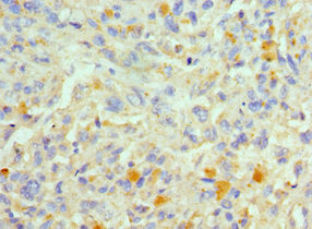 Immunohistochemistry of paraffin-embedded human melanoma using CSB-PA623788ESR1HU at dilution of 1:100