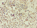Immunohistochemistry of paraffin-embedded human breast cancer using CSB-PA623829ESR1HU at dilution of 1:100