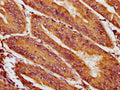 IHC image of CSB-PA623921LA01HU diluted at 1:400 and staining in paraffin-embedded human endometrial cancer performed on a Leica BondTM system. After dewaxing and hydration, antigen retrieval was mediated by high pressure in a citrate buffer (pH 6.0). Section was blocked with 10% normal goat serum 30min at RT. Then primary antibody (1% BSA) was incubated at 4&deg;C overnight. The primary is detected by a biotinylated secondary antibody and visualized using an HRP conjugated SP system.