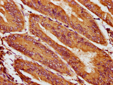 IHC image of CSB-PA623921LA01HU diluted at 1:400 and staining in paraffin-embedded human endometrial cancer performed on a Leica BondTM system. After dewaxing and hydration, antigen retrieval was mediated by high pressure in a citrate buffer (pH 6.0). Section was blocked with 10% normal goat serum 30min at RT. Then primary antibody (1% BSA) was incubated at 4&deg;C overnight. The primary is detected by a biotinylated secondary antibody and visualized using an HRP conjugated SP system.