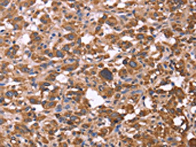 The image on the left is immunohistochemistry of paraffin-embedded Human thyroid cancer tissue using CSB-PA623964(FBXW7 Antibody) at dilution 1/30, on the right is treated with fusion protein. (Original magnification: ×200)