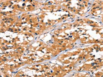 The image on the left is immunohistochemistry of paraffin-embedded Human thyroid cancer tissue using CSB-PA624049(ALOX15 Antibody) at dilution 1/60, on the right is treated with synthetic peptide. (Original magnification: ×200)