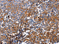 The image on the left is immunohistochemistry of paraffin-embedded Human ovarian cancer tissue using CSB-PA625538(DUSP6 Antibody) at dilution 1/25, on the right is treated with fusion protein. (Original magnification: ×200)