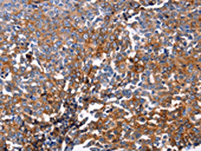 The image on the left is immunohistochemistry of paraffin-embedded Human ovarian cancer tissue using CSB-PA625538(DUSP6 Antibody) at dilution 1/25, on the right is treated with fusion protein. (Original magnification: ×200)
