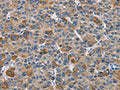 The image on the left is immunohistochemistry of paraffin-embedded Human liver cancer tissue using CSB-PA632606(DNMT3A Antibody) at dilution 1/50, on the right is treated with fusion protein. (Original magnification: ×200)