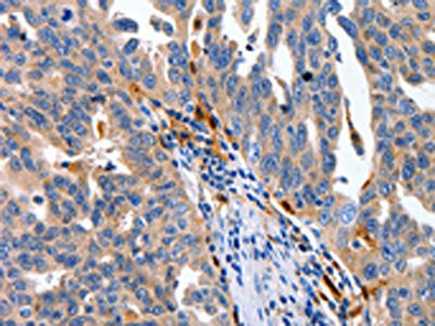 The image on the left is immunohistochemistry of paraffin-embedded Human ovarian cancer tissue using CSB-PA634259(IL18 Antibody) at dilution 1/100, on the right is treated with fusion protein. (Original magnification: ×200)