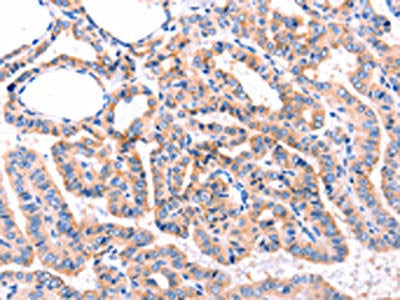 The image on the left is immunohistochemistry of paraffin-embedded Human thyroid cancer tissue using CSB-PA634270(ADRBK1  Antibody) at dilution 1/87, on the right is treated with synthetic peptide. (Original magnification: ×200)