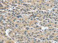 The image on the left is immunohistochemistry of paraffin-embedded Human liver cancer tissue using CSB-PA636640(IGFBP4 Antibody) at dilution 1/25, on the right is treated with fusion protein. (Original magnification: ×200)