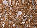 The image on the left is immunohistochemistry of paraffin-embedded Human thyroid cancer tissue using CSB-PA636707(IHH Antibody) at dilution 1/50, on the right is treated with fusion protein. (Original magnification: ×200)