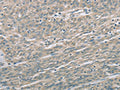 The image on the left is immunohistochemistry of paraffin-embedded Human esophagus cancer tissue using CSB-PA640379(EDA2R Antibody) at dilution 1/60, on the right is treated with fusion protein. (Original magnification: ×200)