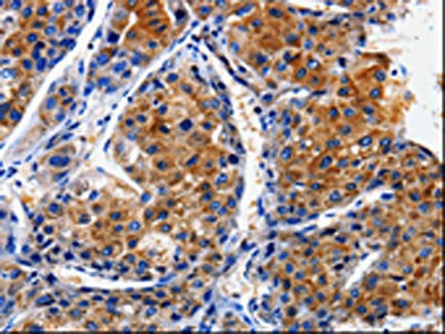 The image on the left is immunohistochemistry of paraffin-embedded Human liver cancer tissue using CSB-PA641512(CLCA4 Antibody) at dilution 1/10, on the right is treated with fusion protein. (Original magnification: ×200)