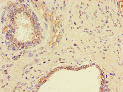 Immunohistochemistry of paraffin-embedded human prostate cancer using CSB-PA643662LA01HU at dilution of 1:100