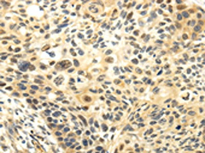 The image on the left is immunohistochemistry of paraffin-embedded Human esophagus cancer tissue using CSB-PA643784(CDKN1A Antibody) at dilution 1/20, on the right is treated with fusion protein. (Original magnification: ×200)