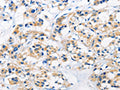 The image on the left is immunohistochemistry of paraffin-embedded Human thyroid cancer tissue using CSB-PA643791(HK1 Antibody) at dilution 1/50, on the right is treated with fusion protein. (Original magnification: ×200)