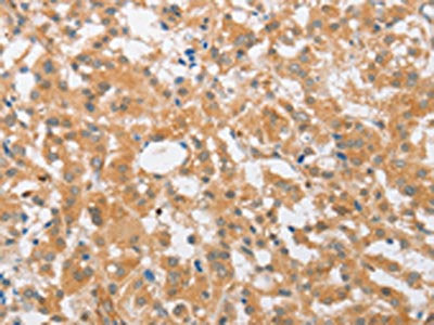 The image on the left is immunohistochemistry of paraffin-embedded Human thyroid cancer tissue using CSB-PA644111(CDKN2C Antibody) at dilution 1/25, on the right is treated with fusion protein. (Original magnification: ×200)