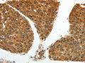 The image on the left is immunohistochemistry of paraffin-embedded Human liver cancer tissue using CSB-PA644570(PSMD14 Antibody) at dilution 1/20, on the right is treated with fusion protein. (Original magnification: ×200)