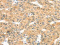 The image on the left is immunohistochemistry of paraffin-embedded Human liver cancer tissue using CSB-PA644665(MAPK12 Antibody) at dilution 1/25, on the right is treated with fusion protein. (Original magnification: ×200)