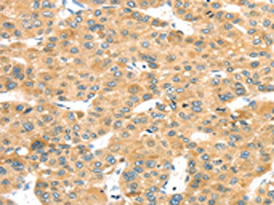 The image on the left is immunohistochemistry of paraffin-embedded Human liver cancer tissue using CSB-PA644665(MAPK12 Antibody) at dilution 1/25, on the right is treated with fusion protein. (Original magnification: ×200)