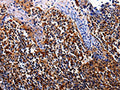 The image on the left is immunohistochemistry of paraffin-embedded Human tosil tissue using CSB-PA645798(IL17RC Antibody) at dilution 1/30, on the right is treated with fusion protein. (Original magnification: ×200)