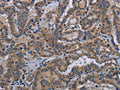 The image on the left is immunohistochemistry of paraffin-embedded Human thyroid cancer tissue using CSB-PA648146(KLK8 Antibody) at dilution 1/30, on the right is treated with fusion protein. (Original magnification: ×200)